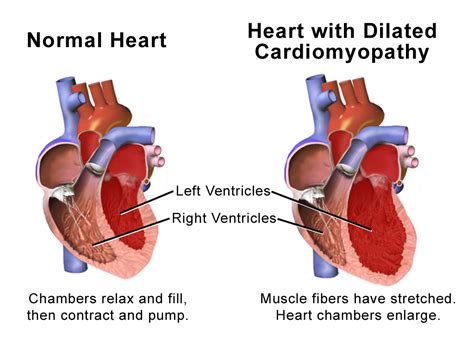 how to treat dilated cardiomyopathy